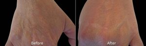 Before & After Photos of Exilis Skin Tightening Not Actual Patients of Dr. Atagi