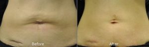 This 2nd Before & After pair shows firmer, smoother skin on the belly after a series of treatments.